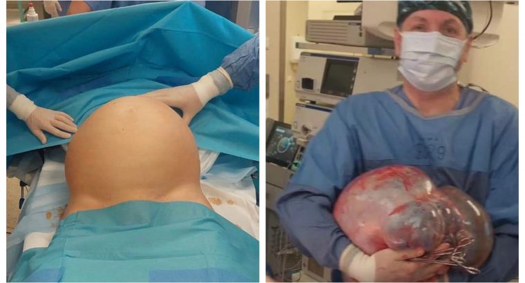 Lekarze z USK w Białymstoku usunęli pacjentce olbrzymiego guza z jamy brzusznej 